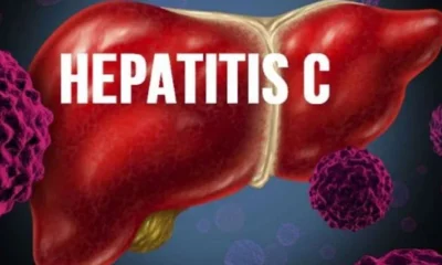 hepatitis