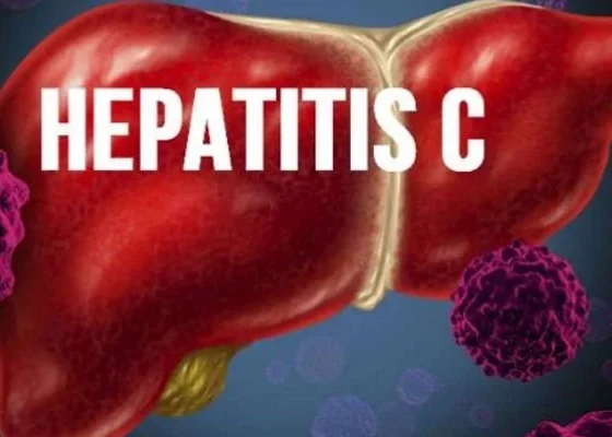 hepatitis