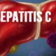 hepatitis